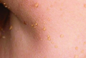 Remove Milia Seeds Skin Tags at MEROSKIN