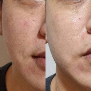 DUO Hydrogen Facial (90mins, Trial) at MEROSKIN