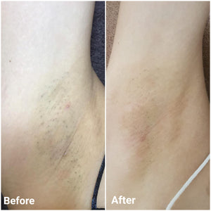 SHR Underarm Super Hair Removal (Trial) - MEROSKIN