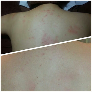 Back Acne Treatment - MEROSKIN