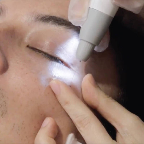 Remove Milia Seeds Skin Tags Treatment (1st Trial, 5 seeds) - MEROSKIN